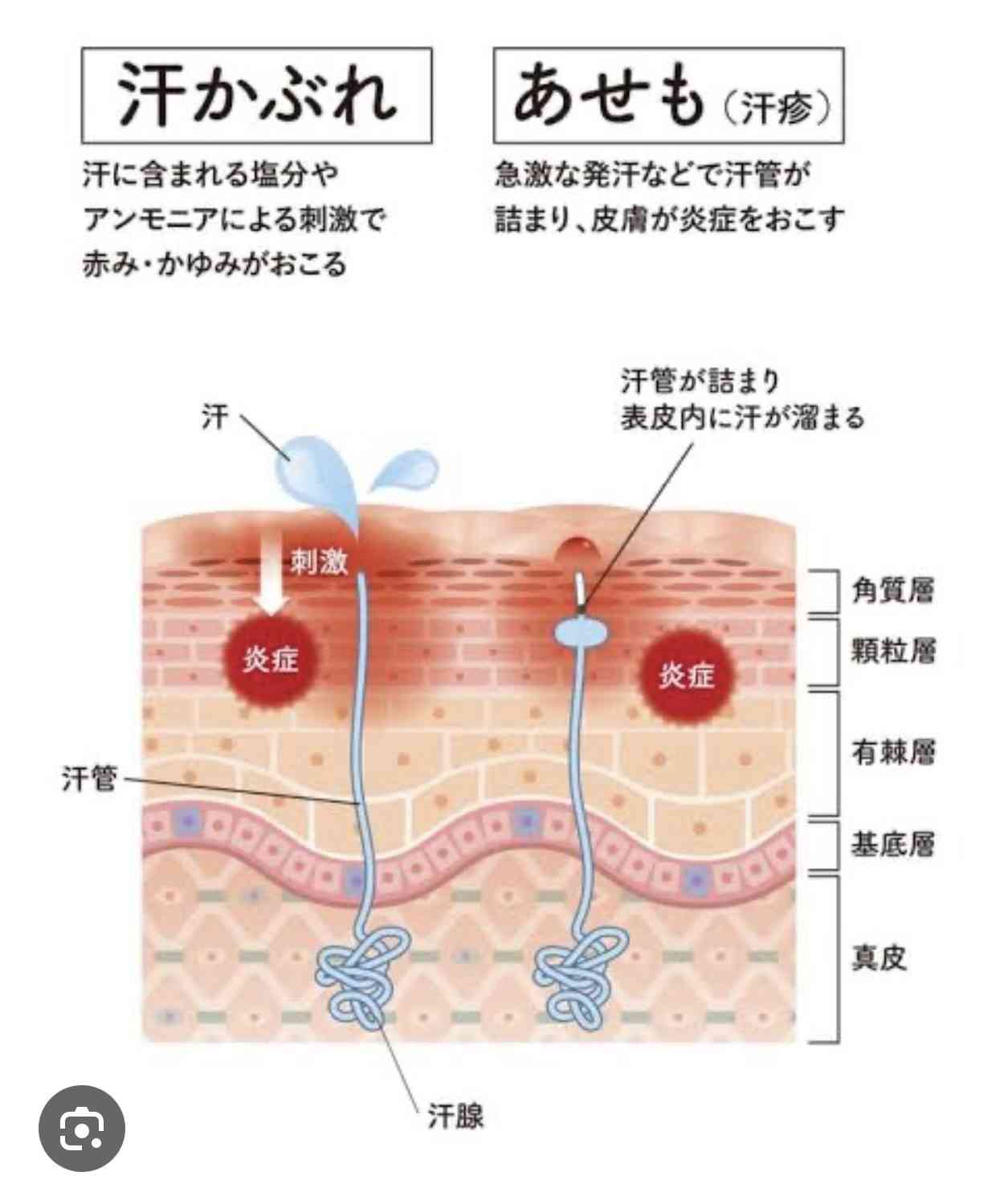 あせも対策