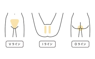 VIO脱毛を検討している