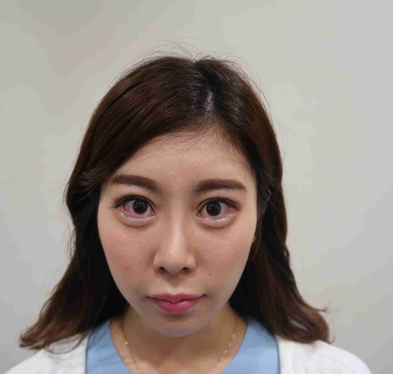 ヒアルロン酸チンダル現象による不自然な涙袋の例
