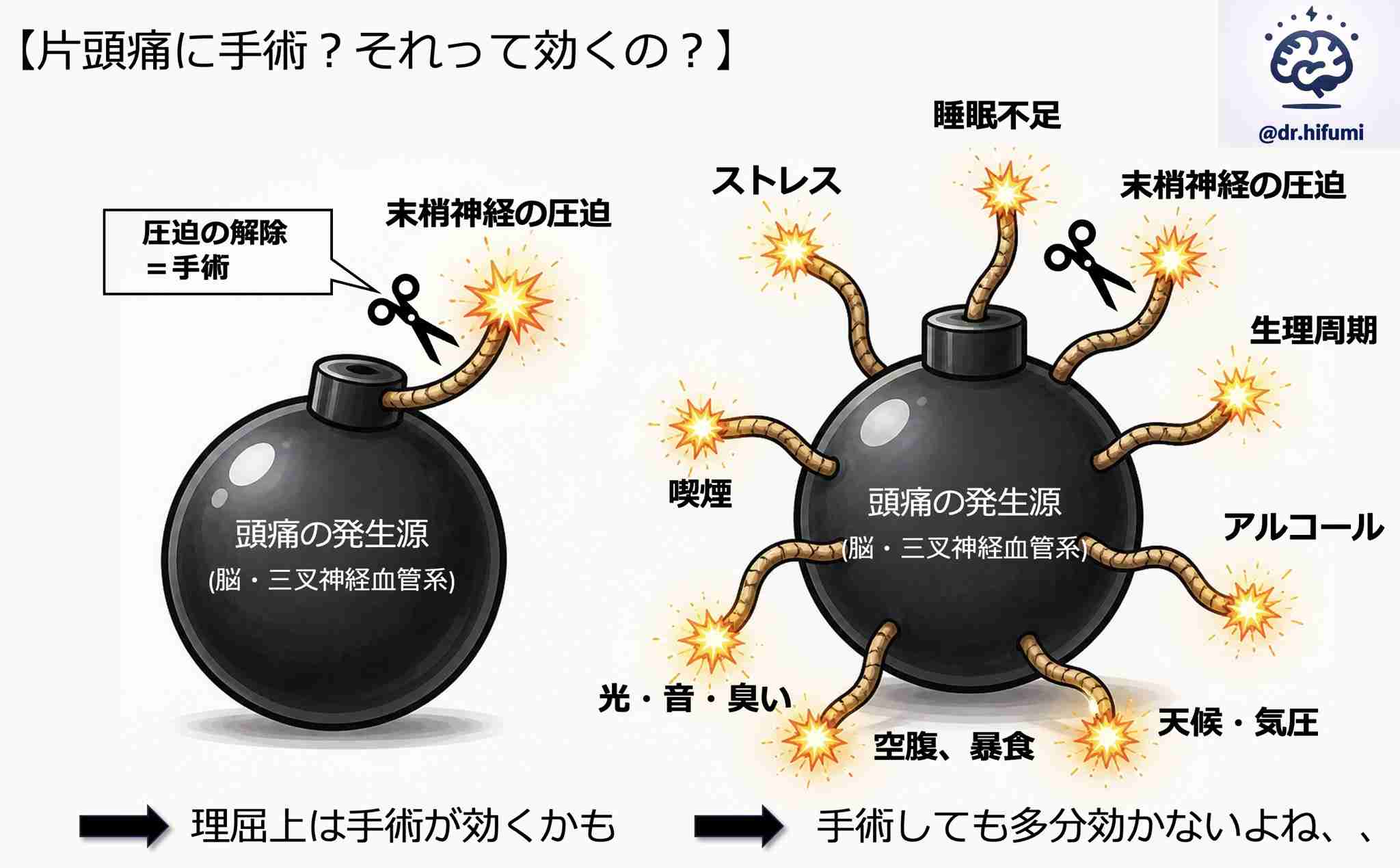 片頭痛