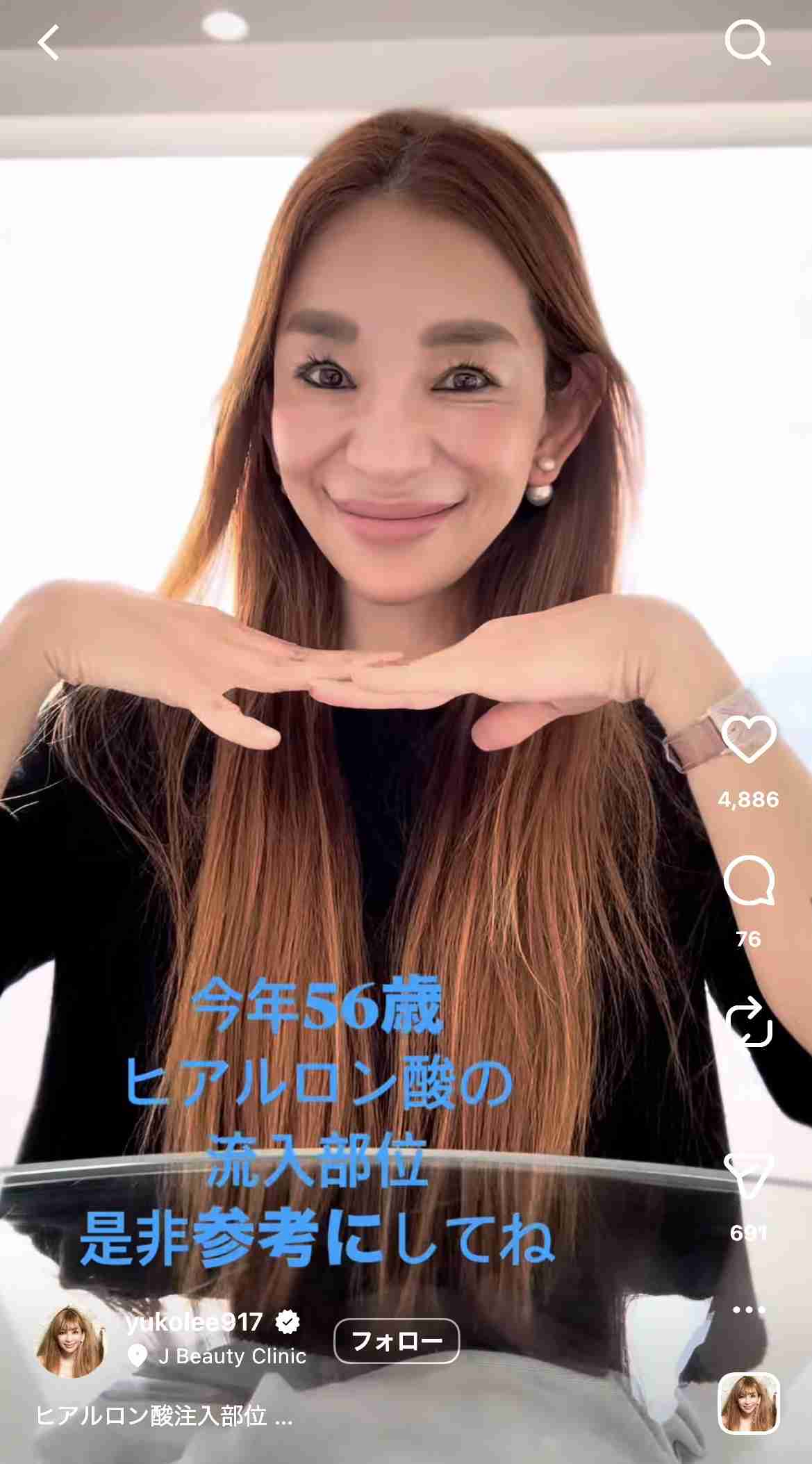 【整形】加齢によるたるみを取りたい