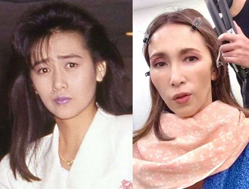 【整形】加齢によるたるみを取りたい