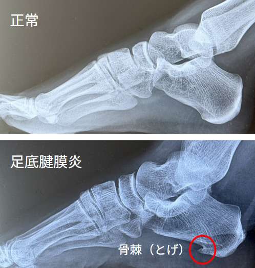 足底筋膜炎になった事ある人!