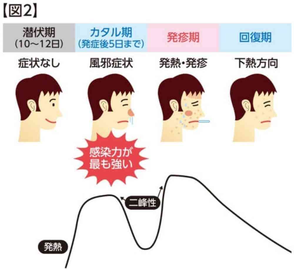 はしか患者、昨年の4倍に急増　感染力はインフルの10倍…GW中の拡大懸念
