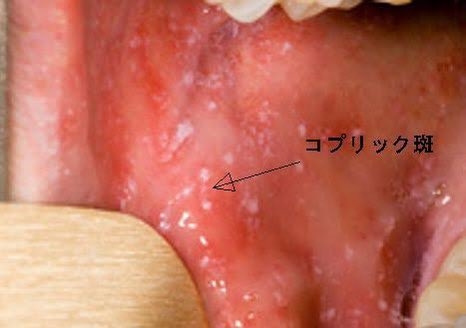 はしか患者、昨年の4倍に急増　感染力はインフルの10倍…GW中の拡大懸念