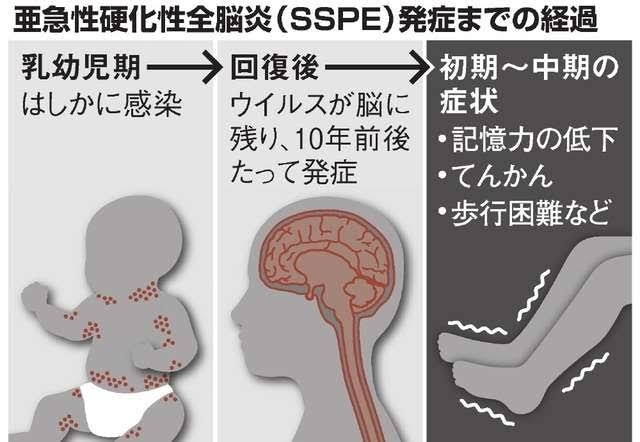 はしか患者、昨年の4倍に急増　感染力はインフルの10倍…GW中の拡大懸念