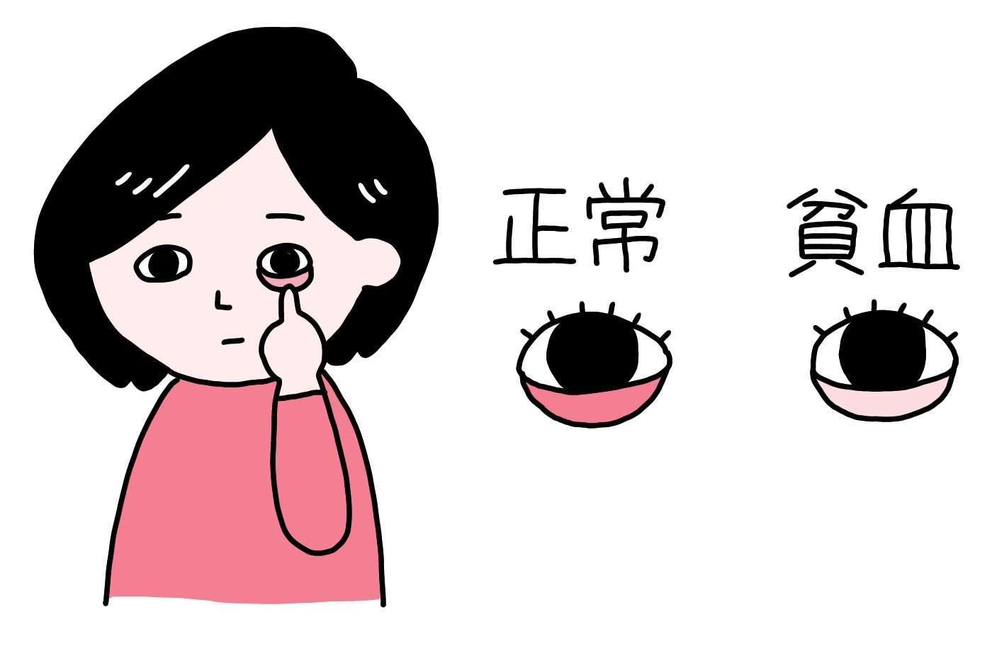 下まぶたの色で貧血チェックする方法