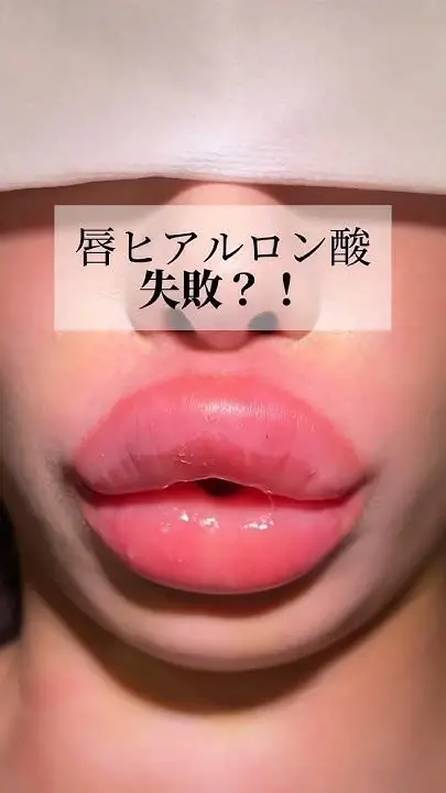 唇を厚くしてみたい(ヒアルロン酸？)