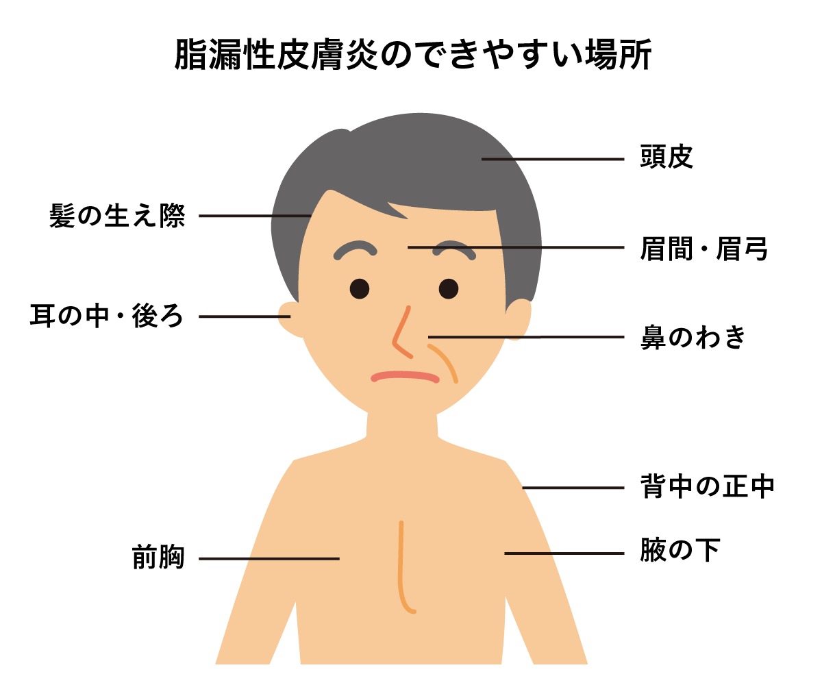 脂漏性皮膚炎経験者の方