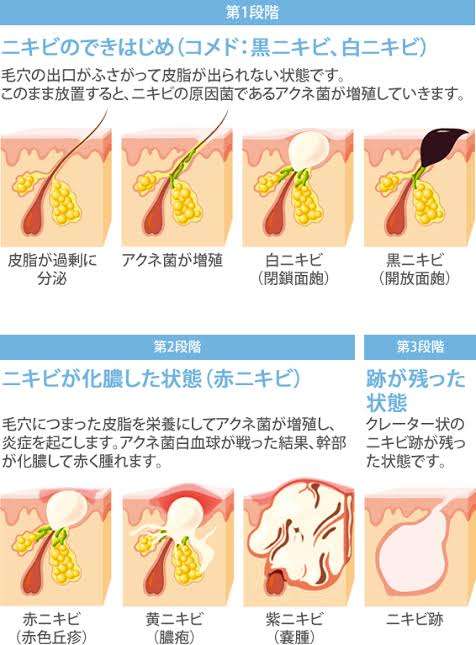 生理前めちゃくちゃ肌荒れする人