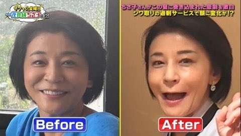 ボトックス失敗