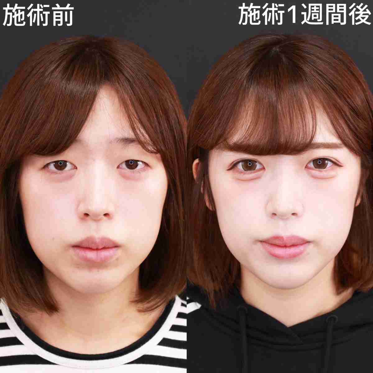 安室奈美恵、佐々木希といった2000年代を代表する美女にはハッキリとないが、今みたいに涙袋があった方が可愛いという価値観はいつ頃から定着したのか