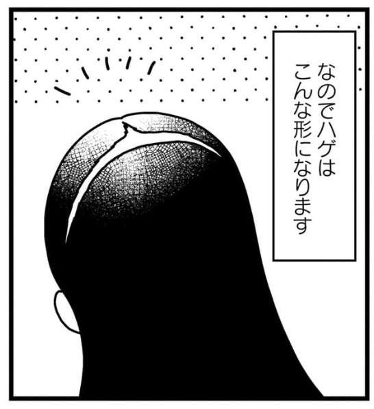 前髪の薄毛が気になる状態のイメージ