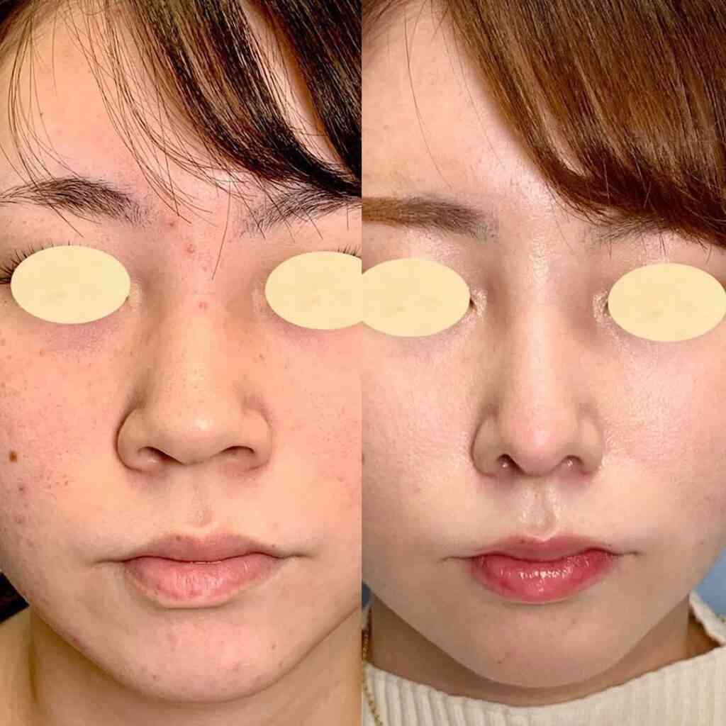 【助けて】鼻の穴が大きい！何とかしたい【教えて】