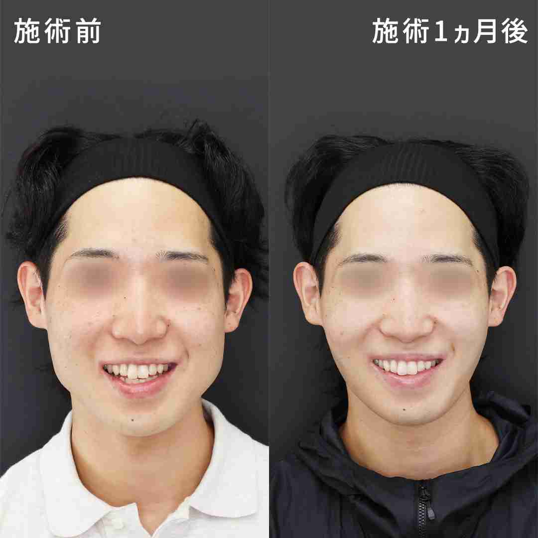 【顔面】エラってあった方が綺麗じゃない？