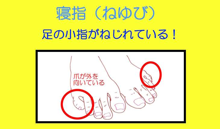 寝指の人どうしてますか