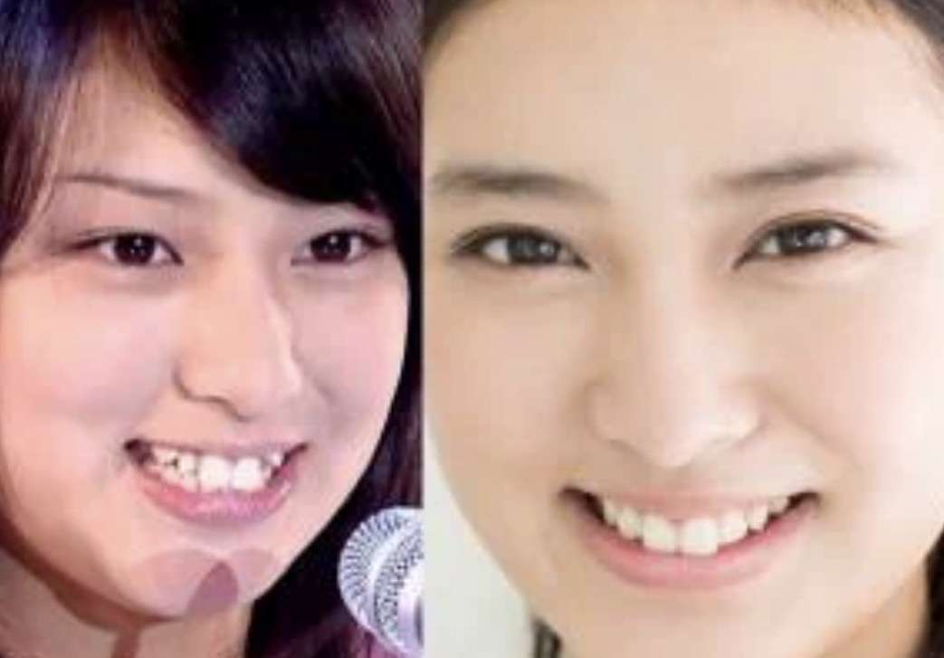 最近の芸能人はなぜあんなに歯並びがいいの?