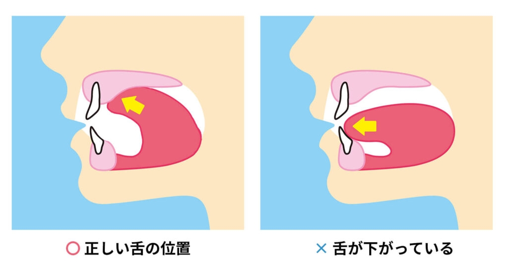 お口がぽかん 子どもの口腔機能発達不全症が全国で増加 昔ながらの遊び減少も原因に