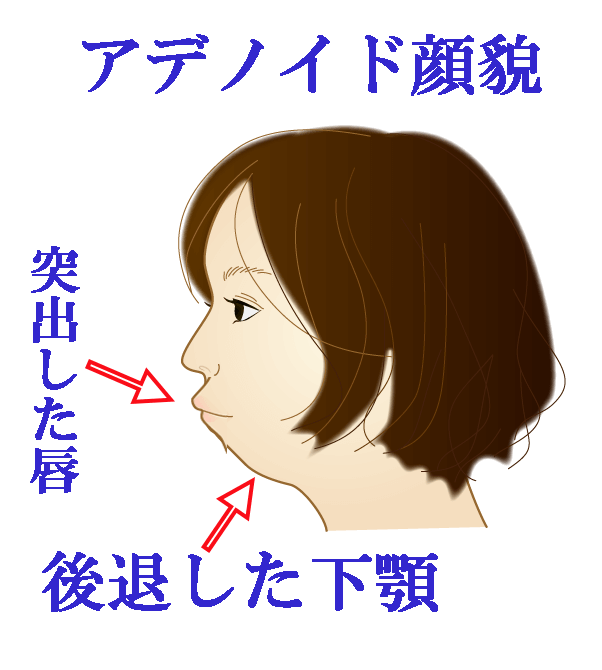 お口がぽかん 子どもの口腔機能発達不全症が全国で増加 昔ながらの遊び減少も原因に