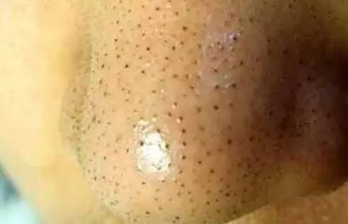 投稿者が公開した毛穴ケアの様子
