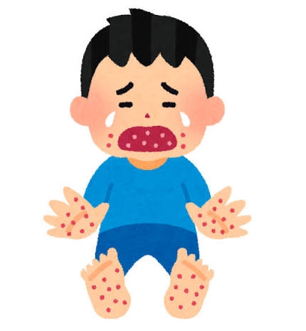 手足口病の経験談