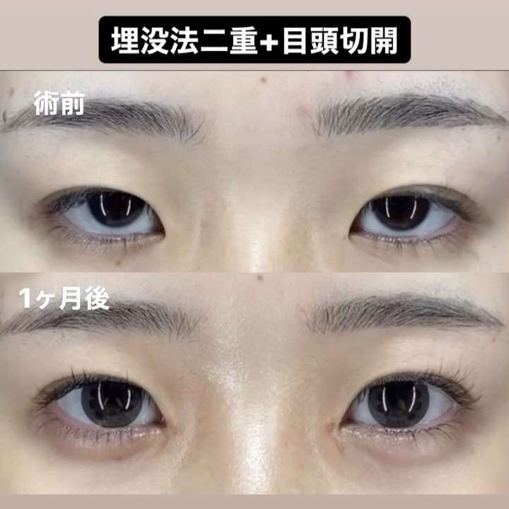 二重埋没の変化を比較した画像