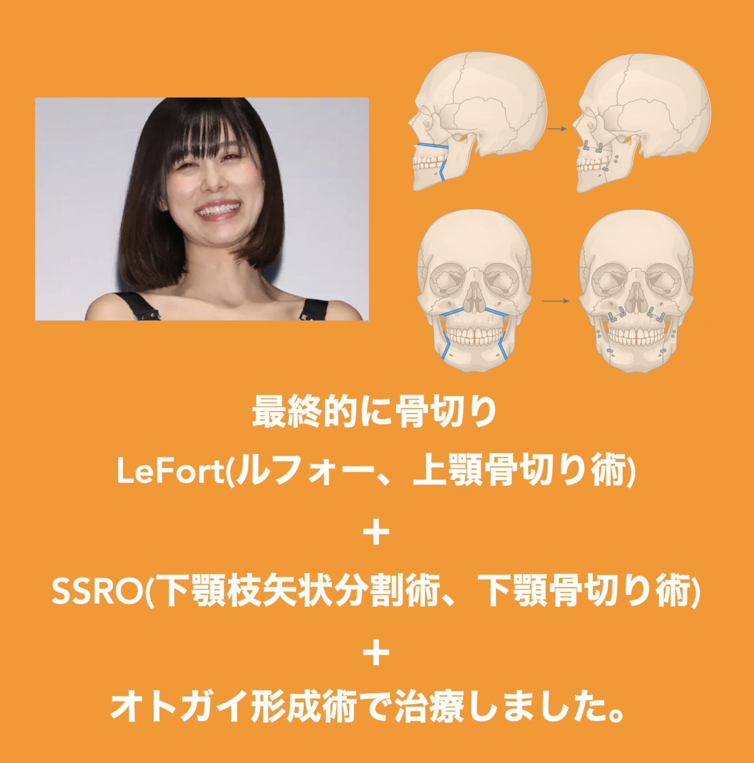 ヒアルロン酸注射「やりすぎ」の反動 ハリウッドセレブが相次ぎ除去、それでもフィラー人気が続く理由