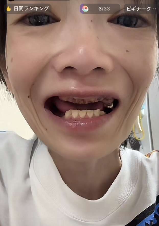 30代後半で歯がない旦那にイライラする