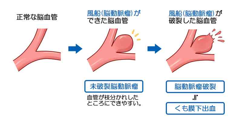 脳動脈瘤が見つかりました。