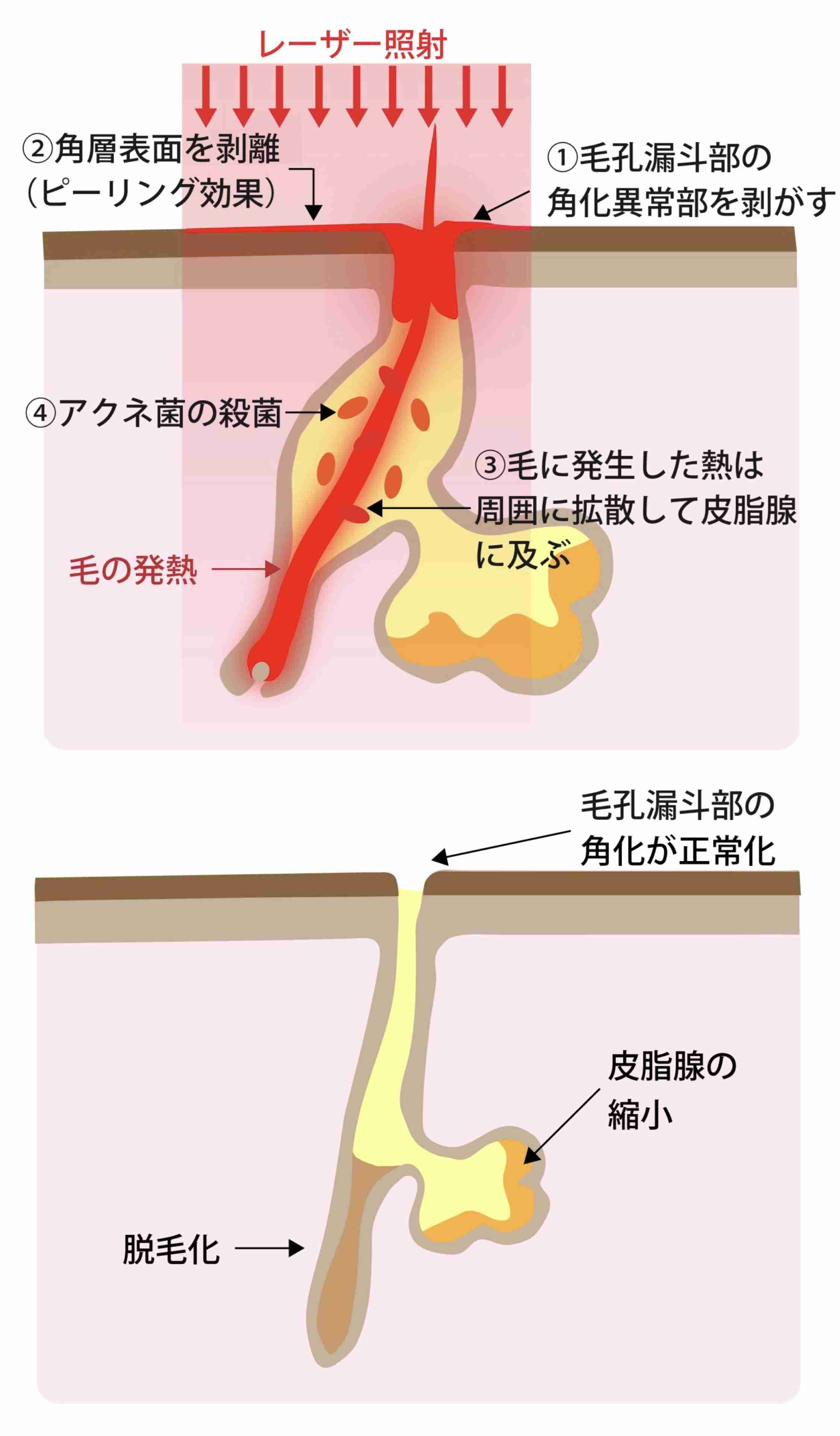 【助けて】ピルをやめたらニキビ・皮脂が激増…同じ方どうしてますか？