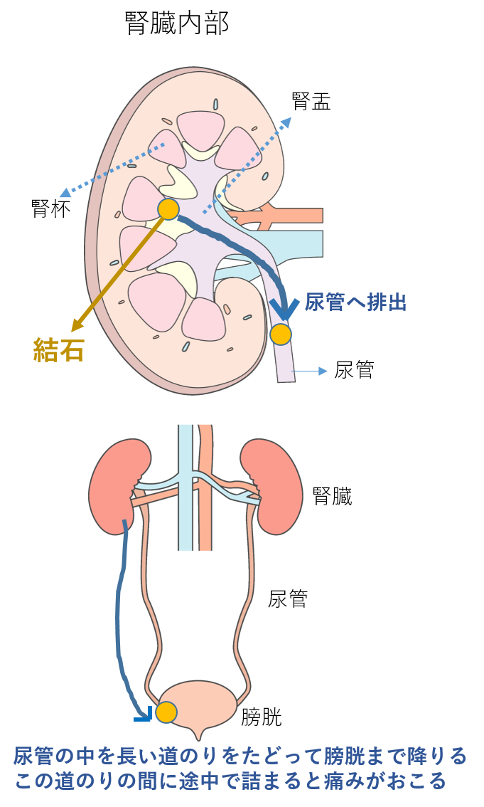 尿管結石について教えてください