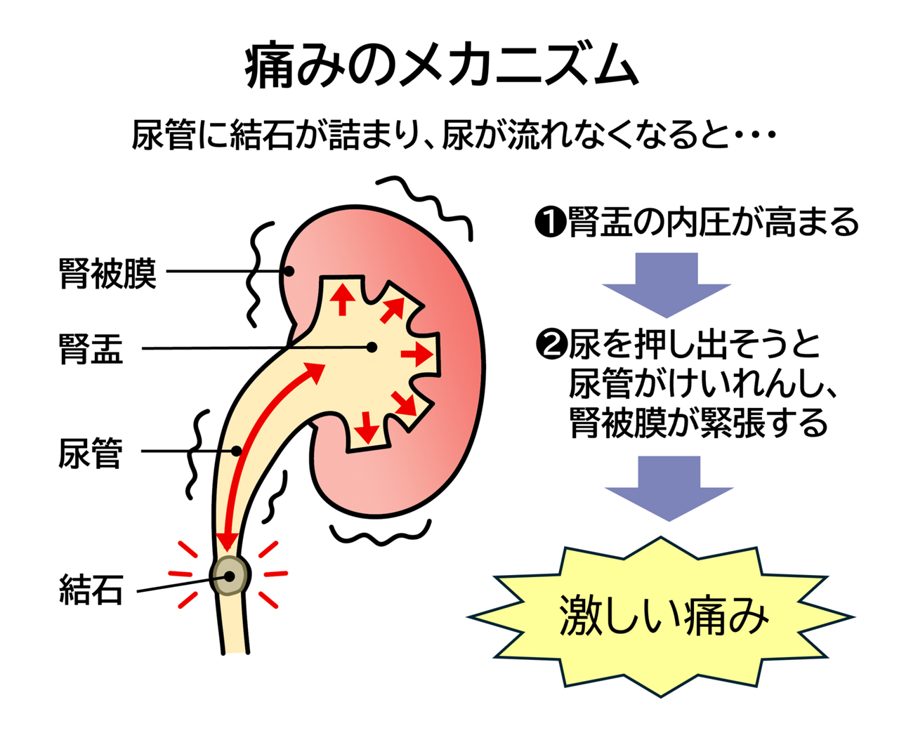 尿管結石について教えてください