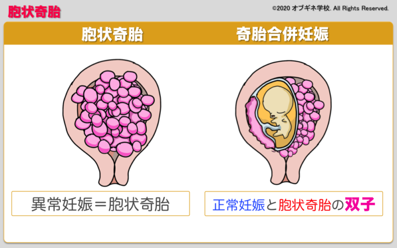 胞状奇胎になったことがある方