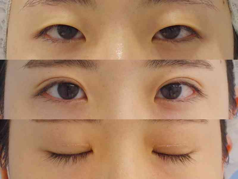 美容医療、進む低年齢化 目立つまぶた整形、親の意向も 専門家「丁寧なカウンセリングを」