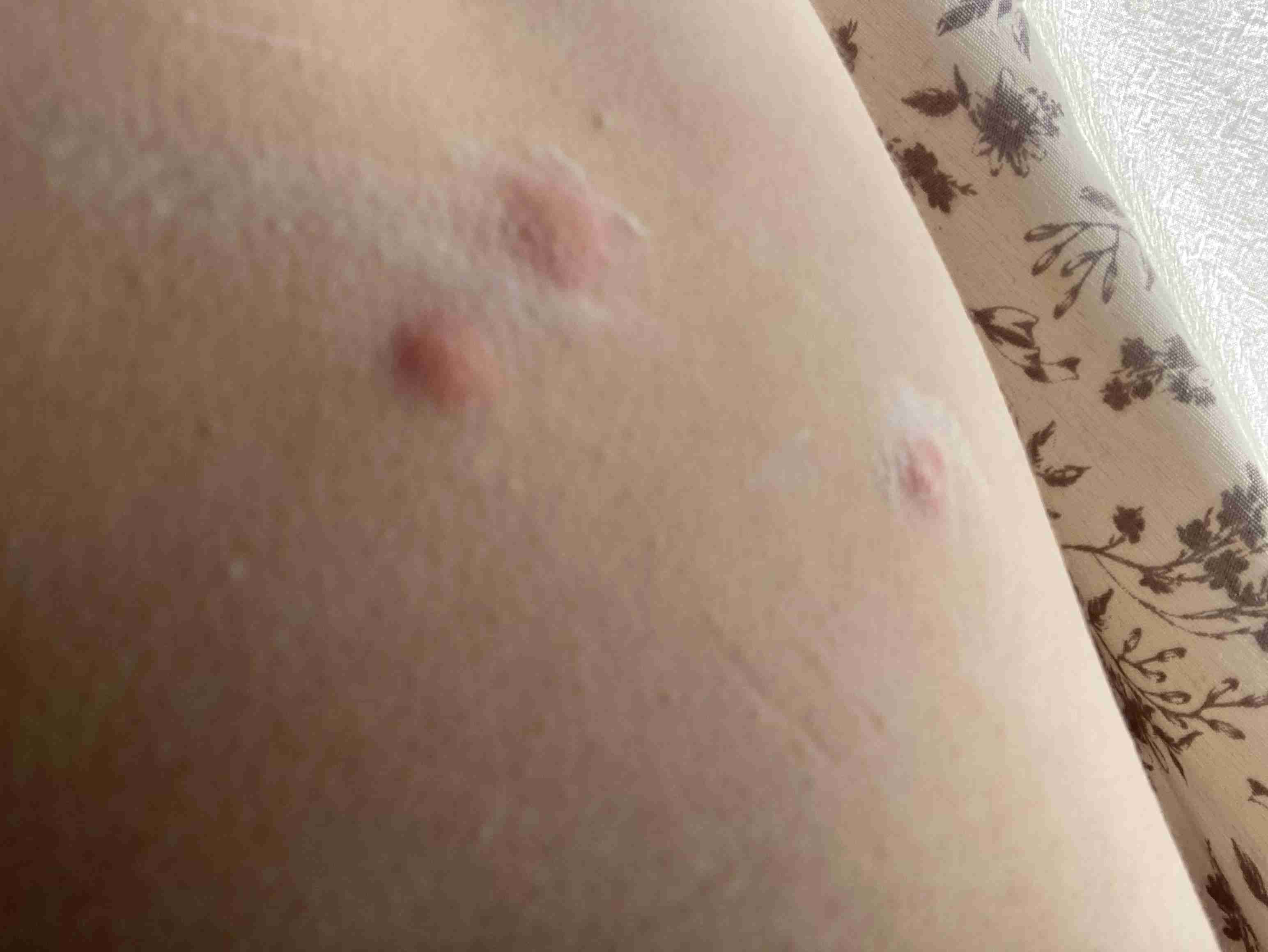ダニに刺されて気が狂いそう