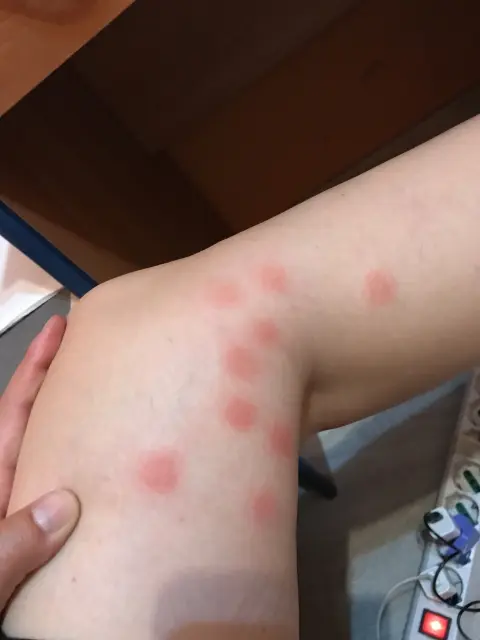 ダニに刺されて気が狂いそう