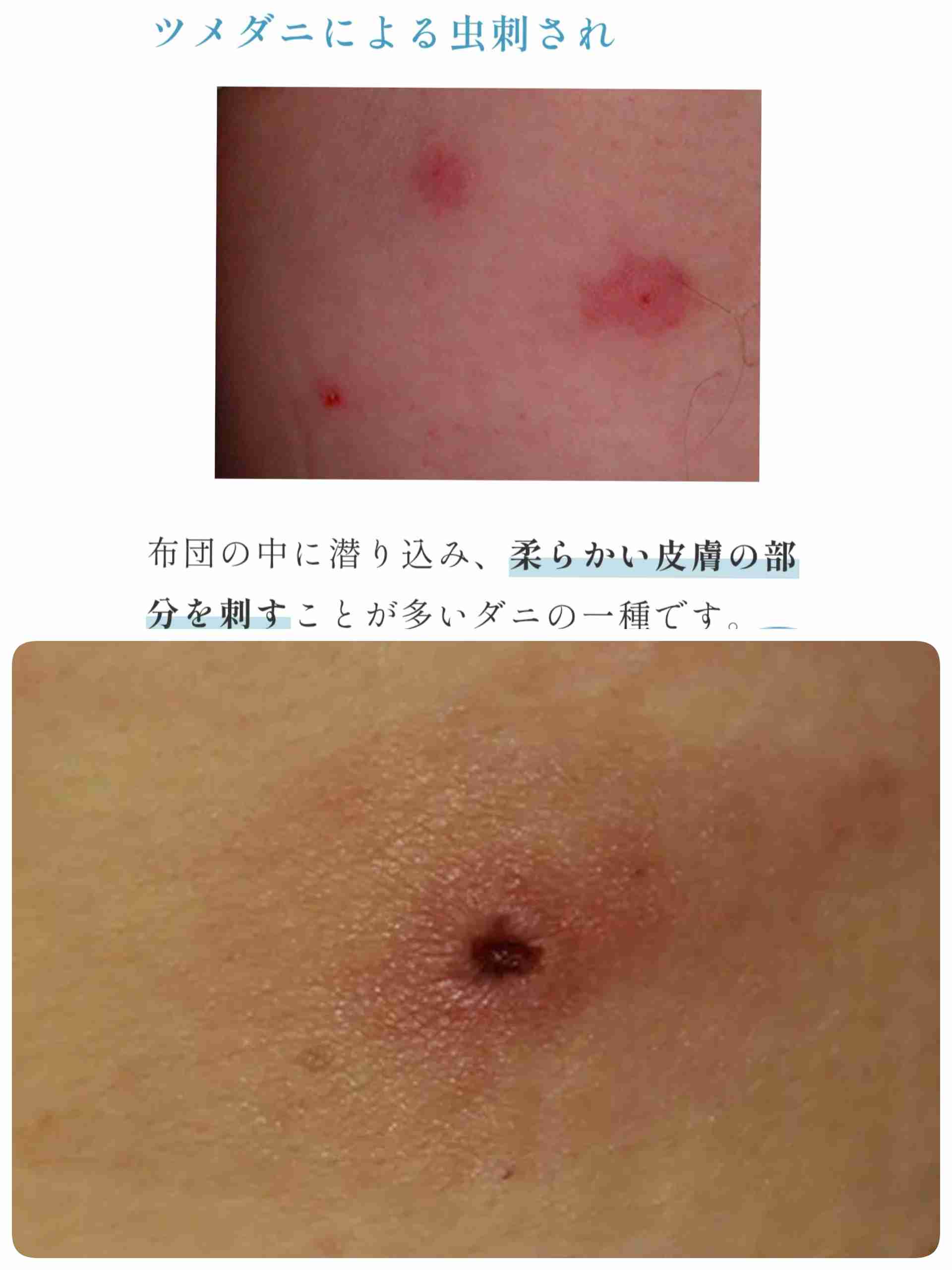 ダニに刺されて気が狂いそう