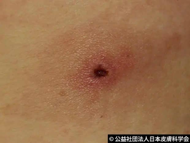 ダニに刺されて気が狂いそう
