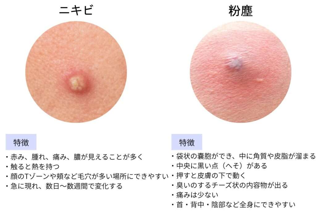お尻のニキビについて
