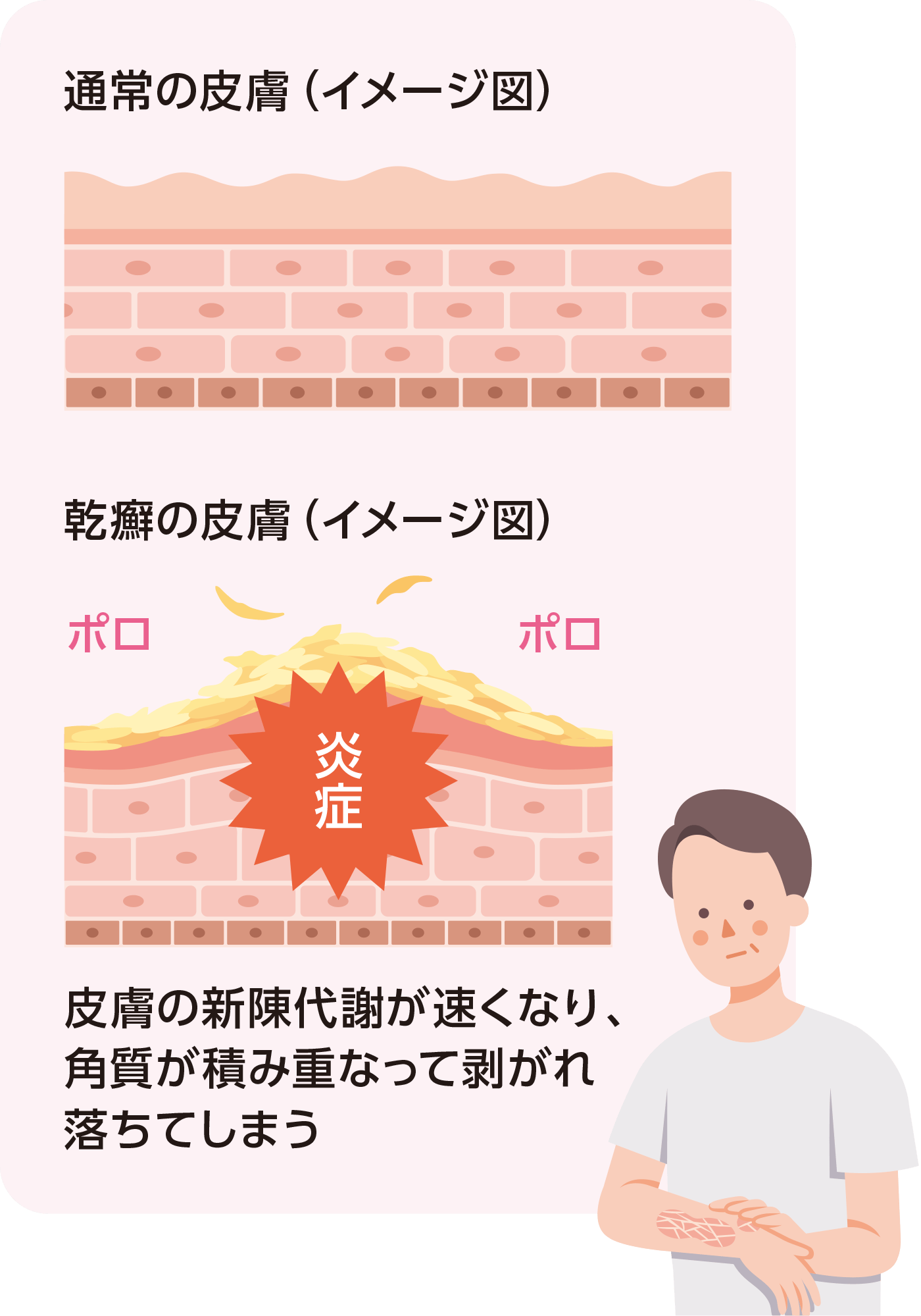 乾癬の方!(なったことがある方)