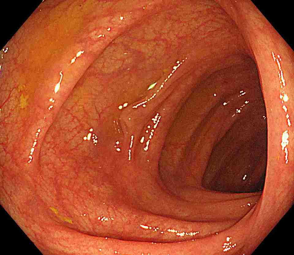 大腸検査が恐い