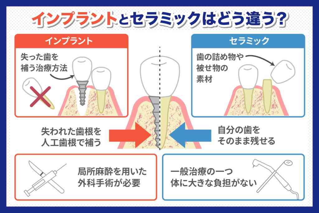 インプラントについて