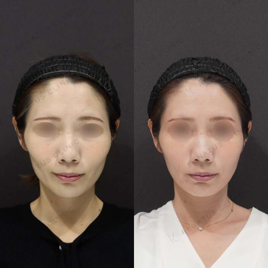 体が痩せると頬がこける…