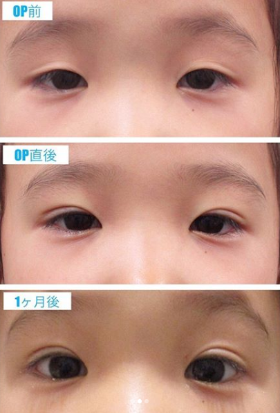 加速する美容整形の低年齢化　背景に「SNSの影」