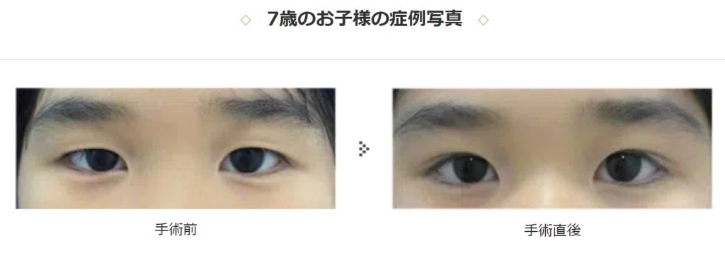 加速する美容整形の低年齢化　背景に「SNSの影」