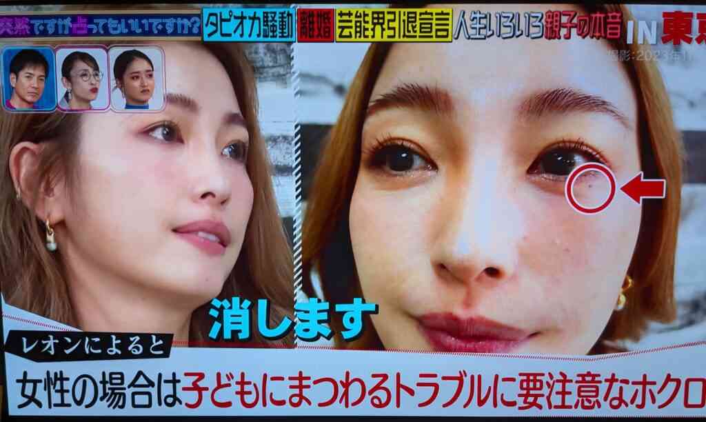ホクロ取りと運勢