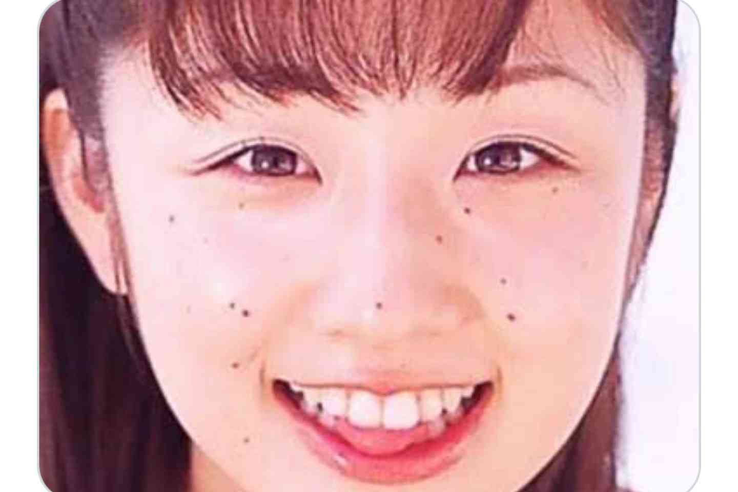 ホクロ取りと運勢