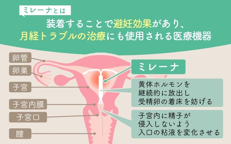 ミレーナの副作用