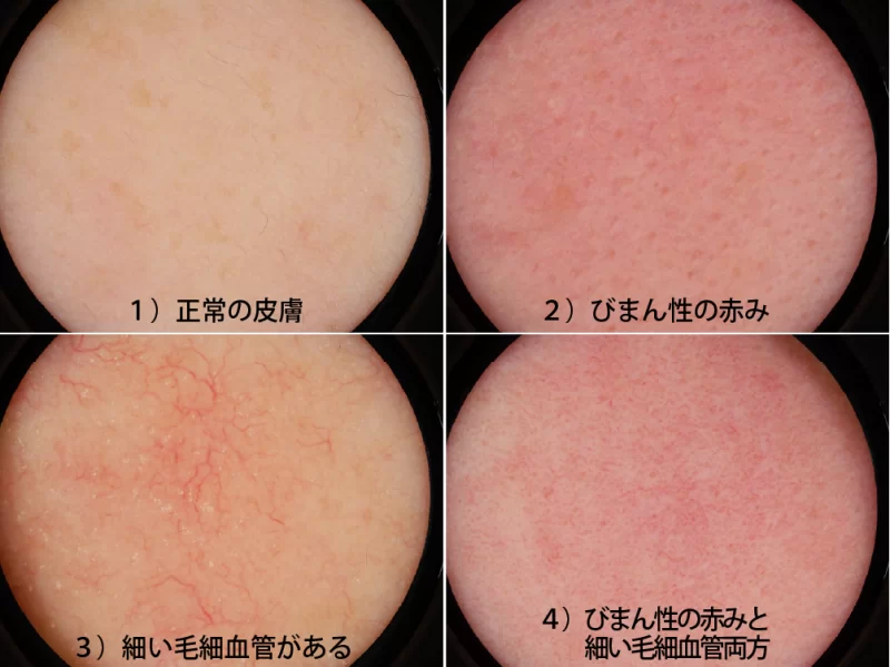 赤ら顔、毛細血管拡張症の治し方