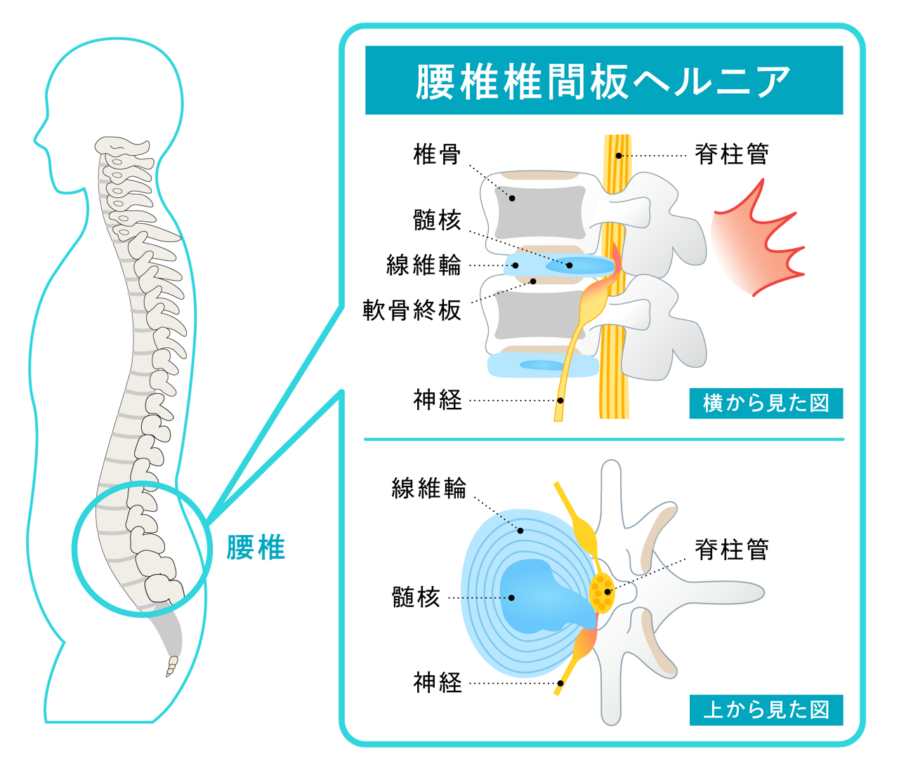 【椎間板ヘルニア】手術した人・しなかった人の話を聞きたい